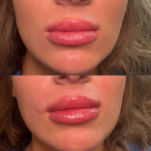 Lip Filler 1 syringe