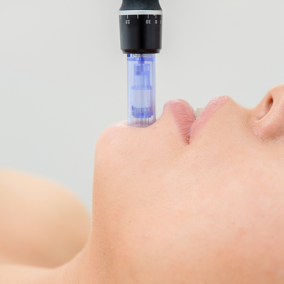 Microneedling