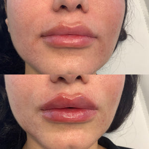Lip Filler 1 syringe