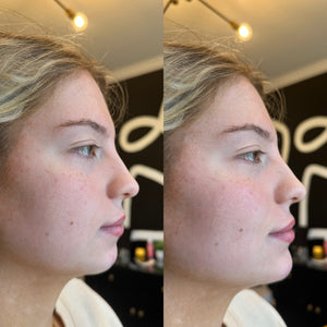 Chin Filler 1 syringe
