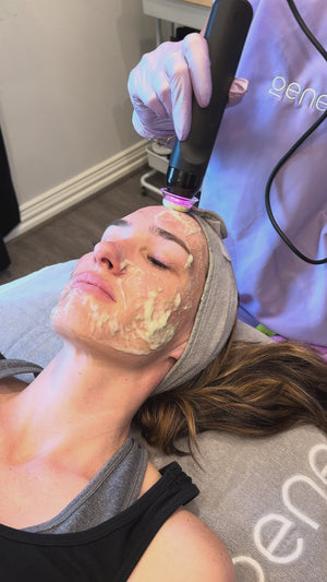 The Bombshell Package: Mini Lip Filler + Free Glo2 Oxygen Facial